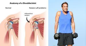 Ways to avoid shoulder shrug